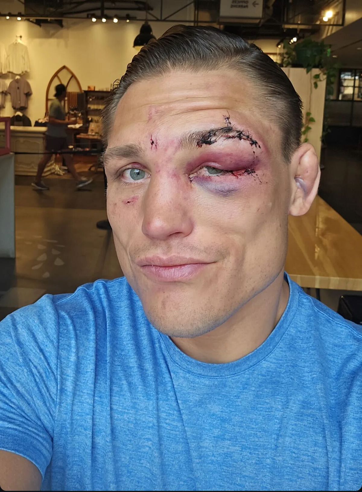 Drew Dobers Eye Injury: UFC Denver Fight Ends in Bloody TKO Loss