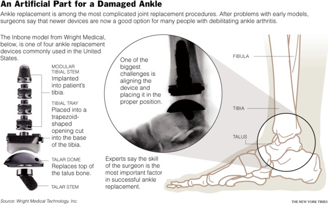 What is ankle bone nyt and why is it trending now?