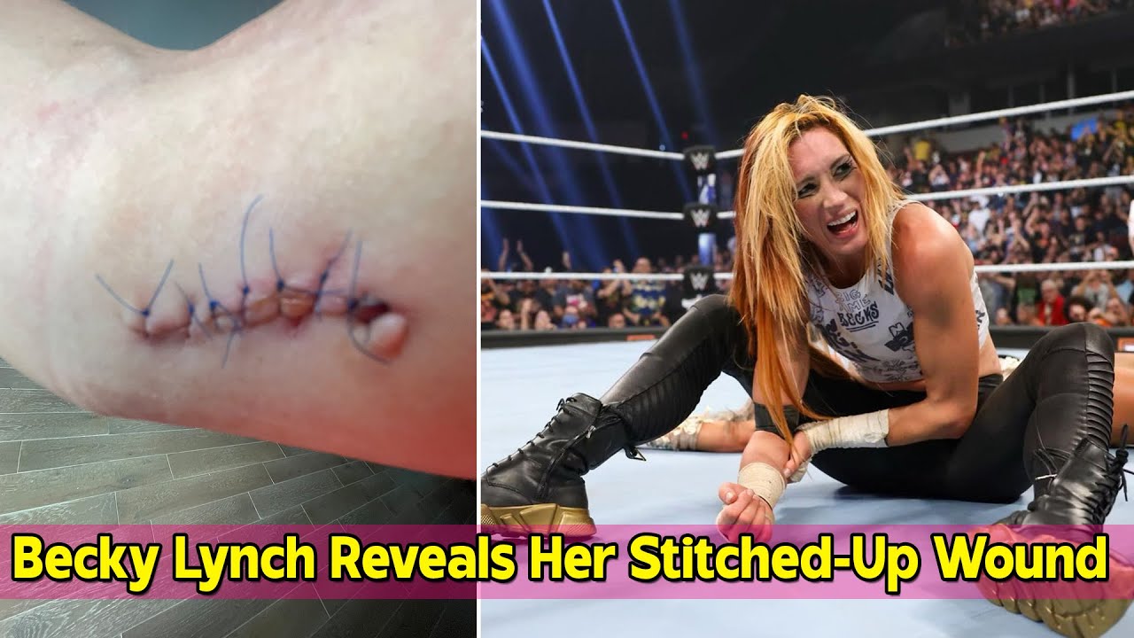 Becky Lynch stitches count: Find out how many stitches she needed after that brutal match!