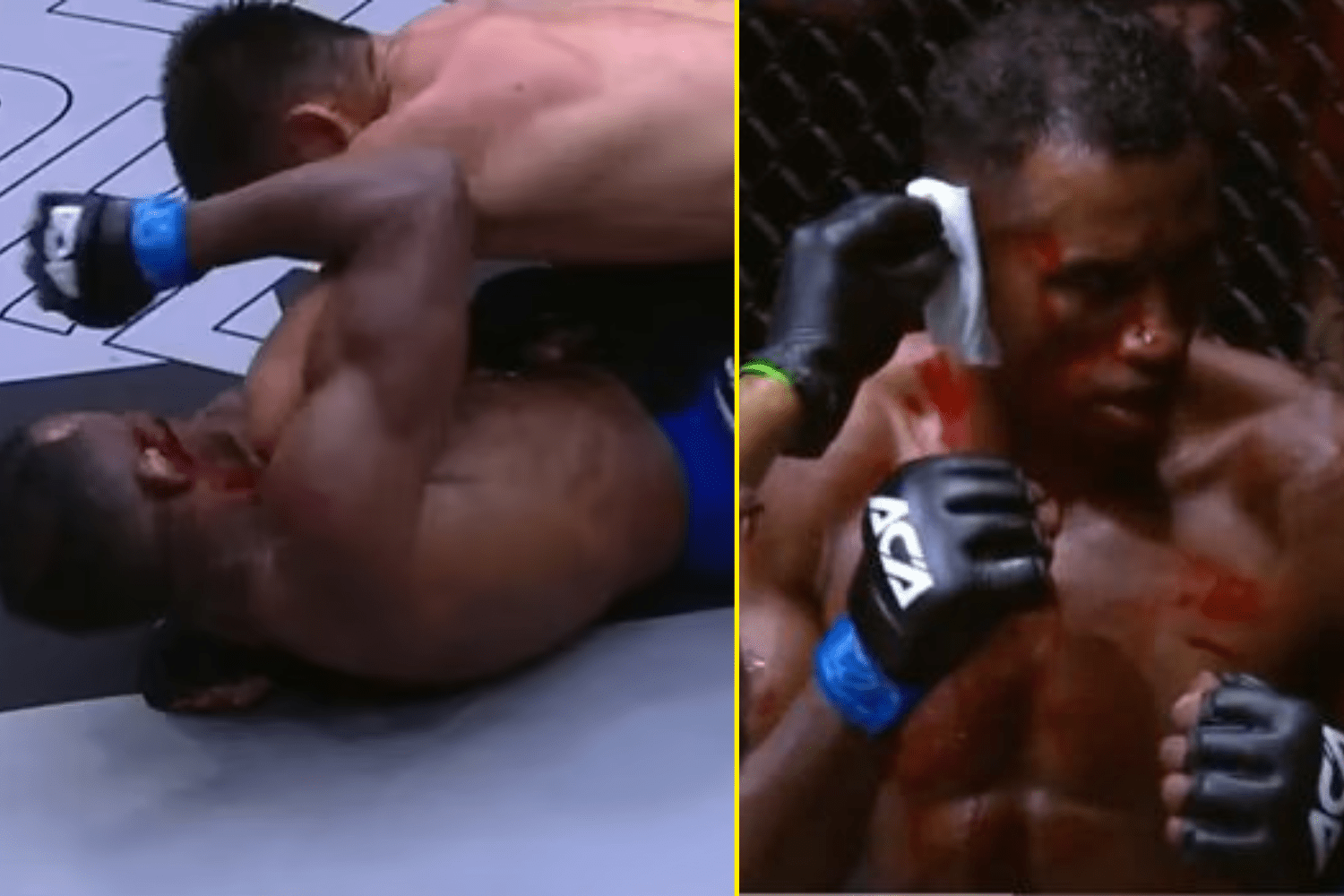 Vinicius Cruzs Ear Injury: This Is Why MMA Can Be So Dangerous