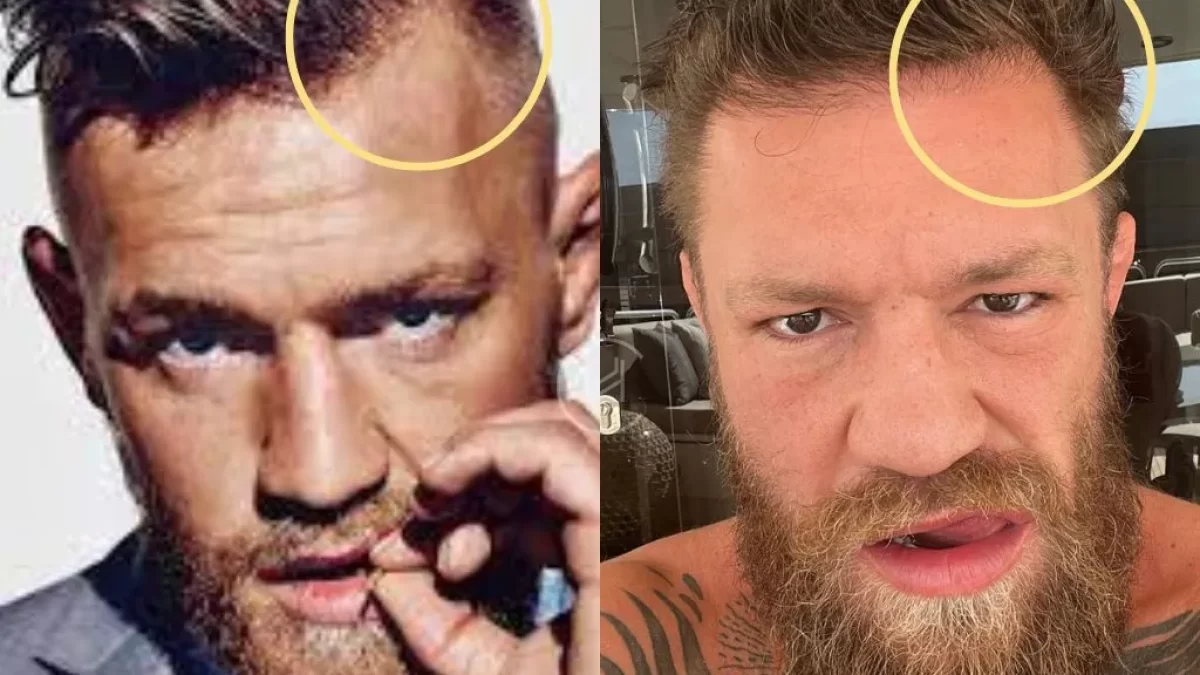 Conor McGregor Balding: Experts Weigh In on His Receding Hairline.