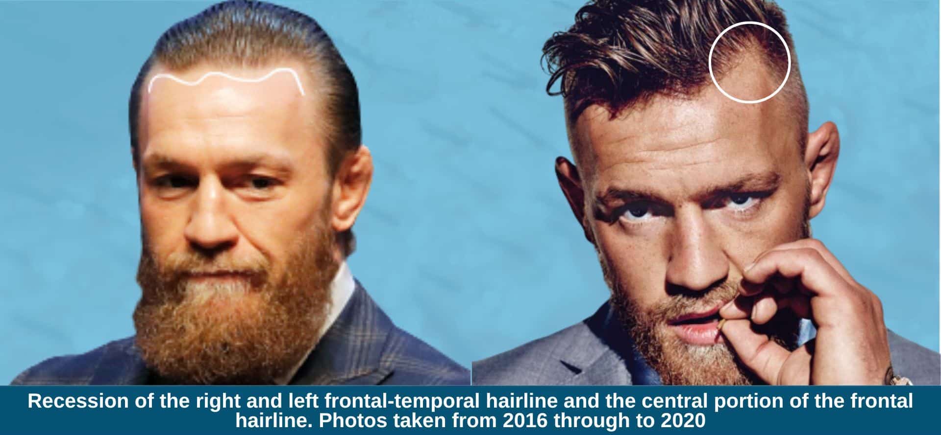 Conor McGregor Hairline: What Happened and Is It Receding?